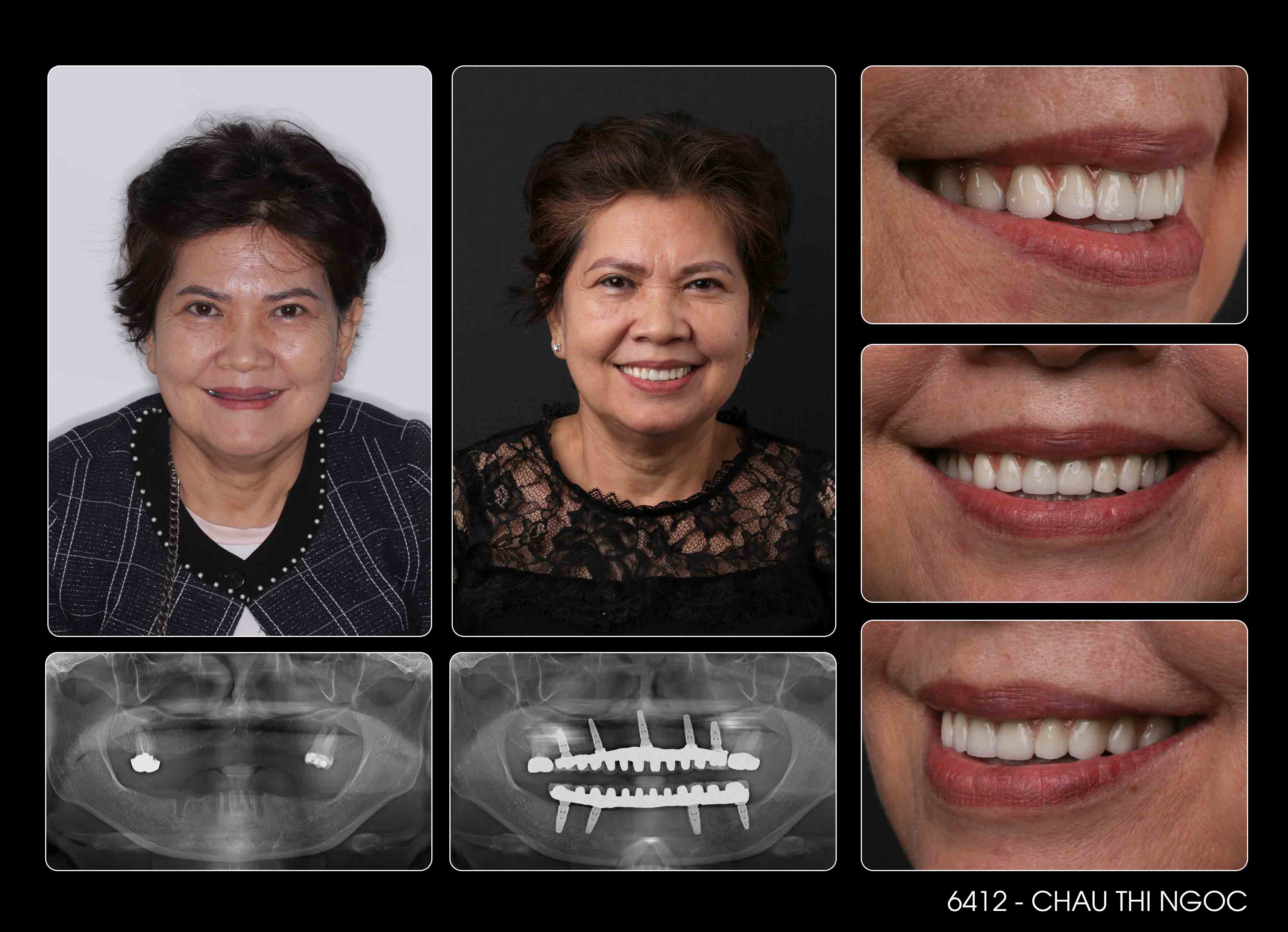 khach-hang-cuoi-tu-tin-sau-cay-implant