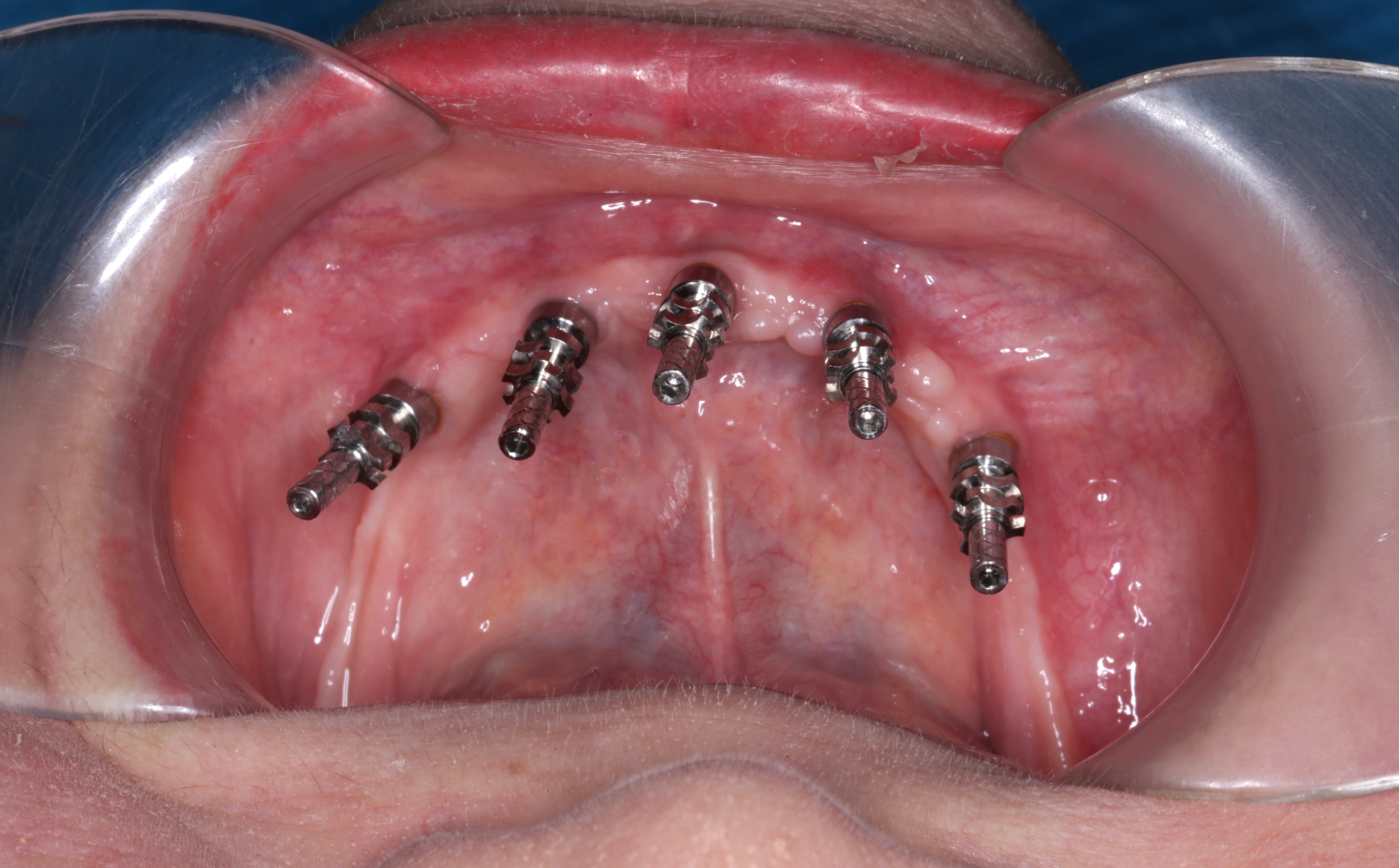 Quy trình cấy trụ Implant tại phòng khám