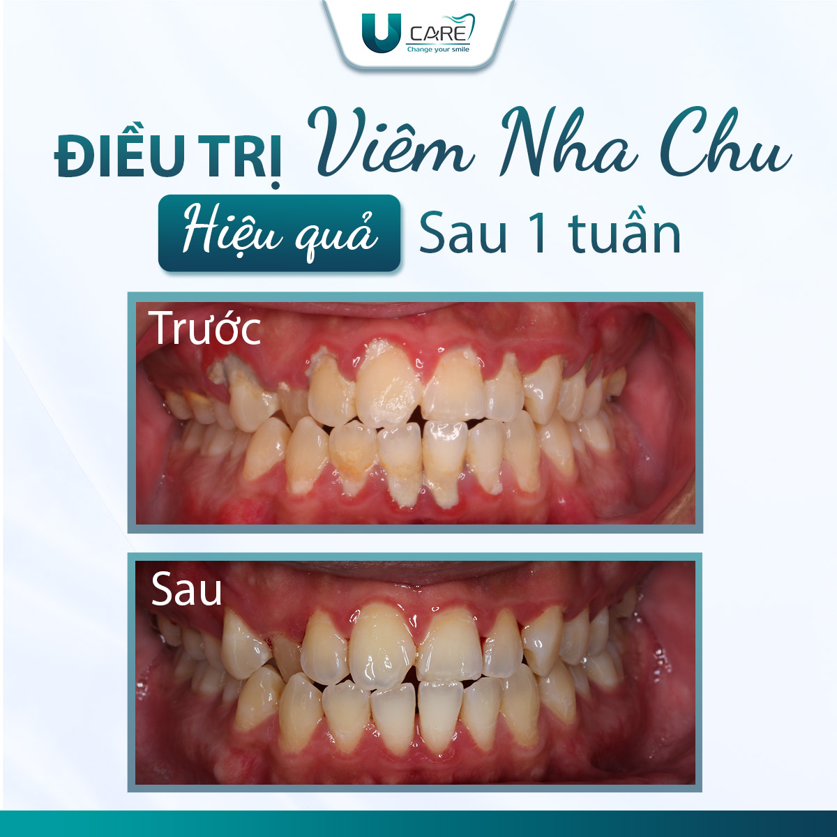 hieu-qua-sau-1-tuan-dieu-tri-bang-laser