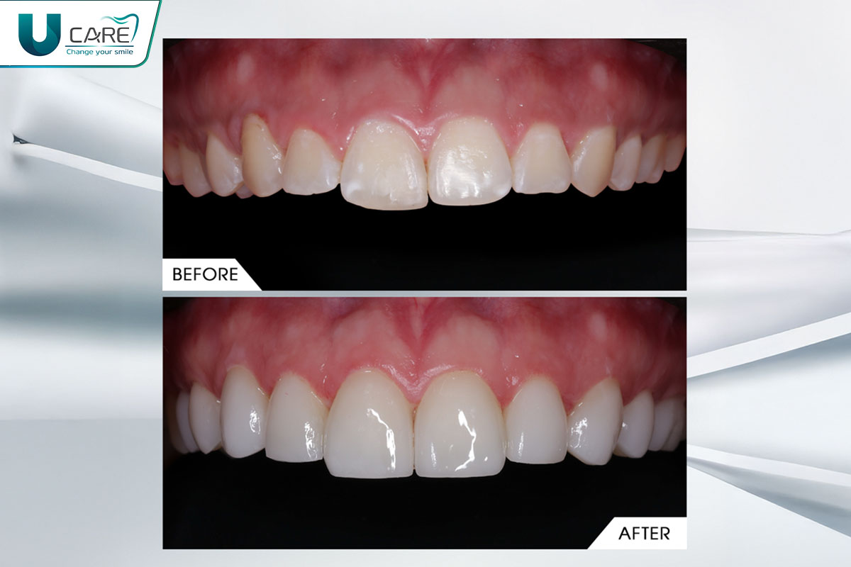 hinh-anh-truoc-va-sau-khi-lam-rang-su